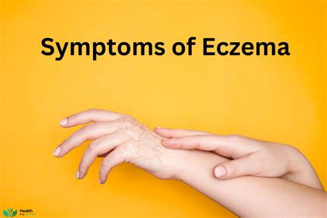 Eczema Symptoms and Treatment