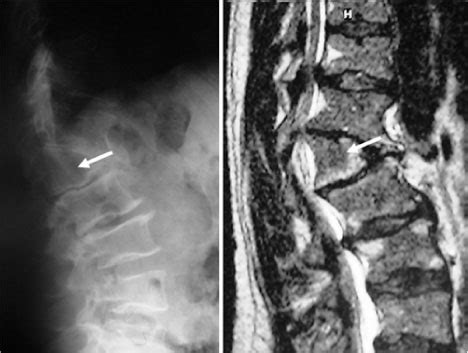 Incidental Vertebral Lesions In Neurosurgical Focus Volume 31 Issue 6