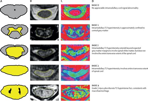 Mri In Traumatic Spinal Cord Injury From Clinical Assessment To