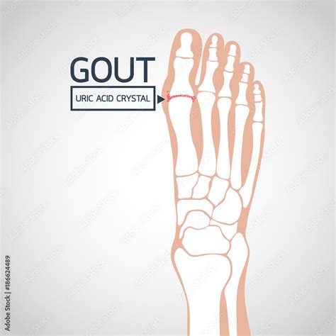 Gout vector logo icon illustration Stock Vector | Adobe Stock