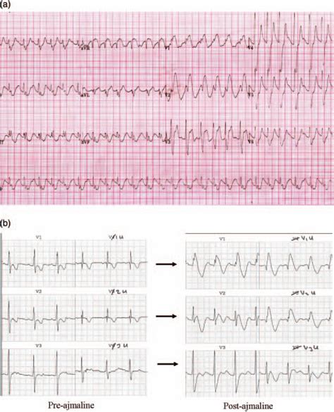 Brugada syndrome. (A) This ECG was taken from an 8-month-old infant ...