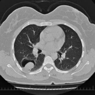 A Postero Anterior Pa Chest X Ray B C Thorax Ct View Of The