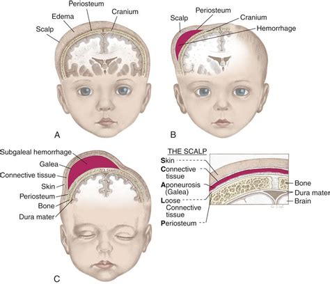 Difference Between Caput Succedaneum And Cephalhematoma How To Heal