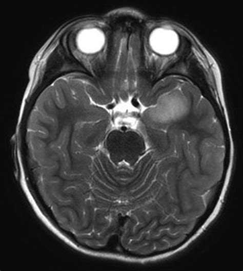 Temporal Lobe Epilepsy | Neupsy Key