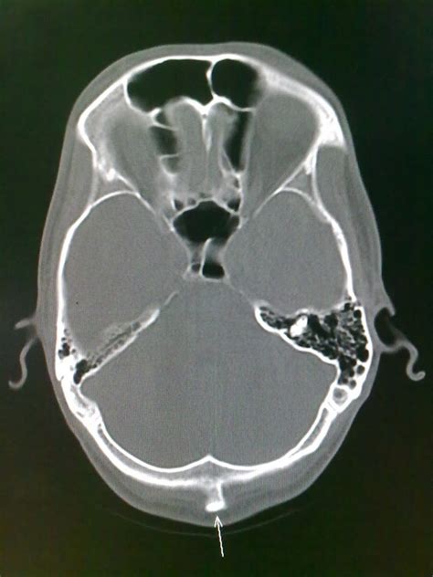 Prominent External Occipital Protuberance - Radiology