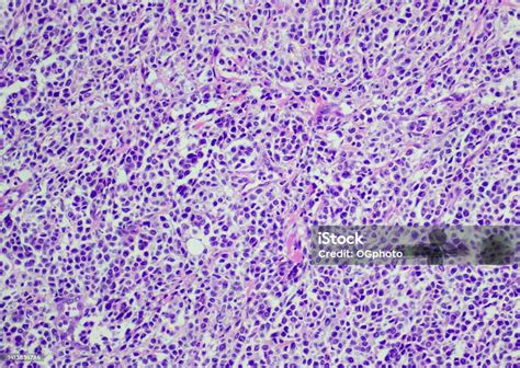 Diffuse Large Cell Lymphoma Stock Photo - Download Image Now - Lymphoma, Biological Cell, Light ...