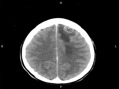 Ring Enhancing Lesion On Ct Scan Metastases Or A Brain Abscess