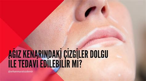 Nazolabial Dolgu Nedir Youtube