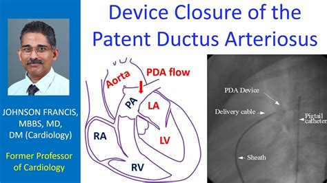 Device Closure Of Patent Ductus Arteriosus Youtube