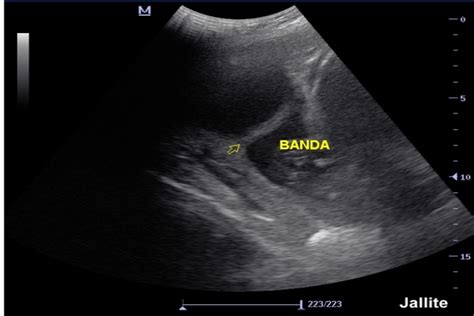 Hallazgos Por Ultrasonido En Escala De Grises Y Doppler En Las Bandas