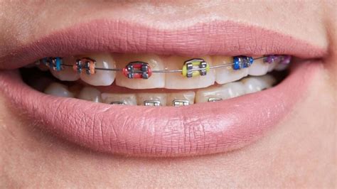 Orthodontic Molar Bands The Ultimate Guide For