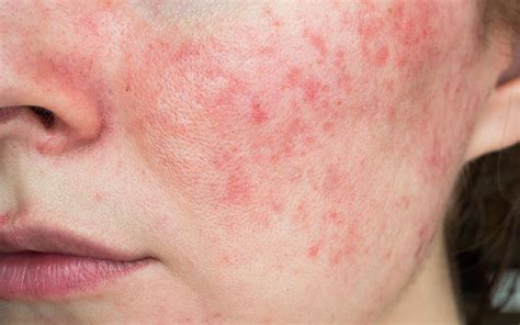 Acne Vulgaris Vs Acne Rosacea Understanding The Difference Skinkraft