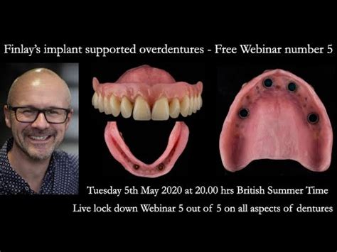 Fin S Webinar Implant Supported Overdentures Protocols To Ensure