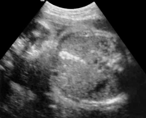 Figure 3 From Fetal Gallstones Semantic Scholar