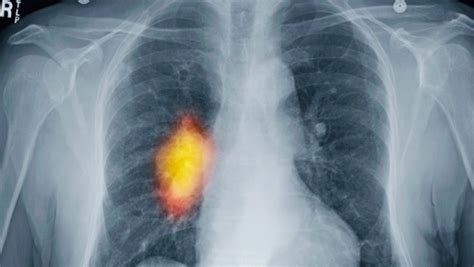 7 Simptome Ale Cancerului Pulmonar Buna Ziua Iasi BZI Ro