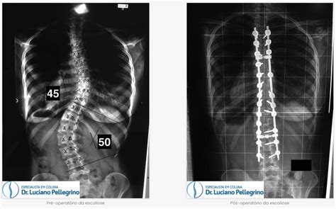 Escoliose Sintomas Diagn Stico Dr Luciano Pellegrino