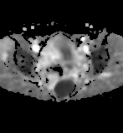 Tailgut Duplication Cyst Image Radiopaedia Org