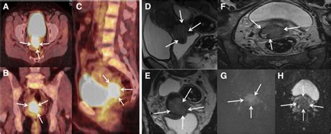 A 47 Year Old Woman With Figo Stage Iib Cervical Cancer With Fdg Avid Download Scientific