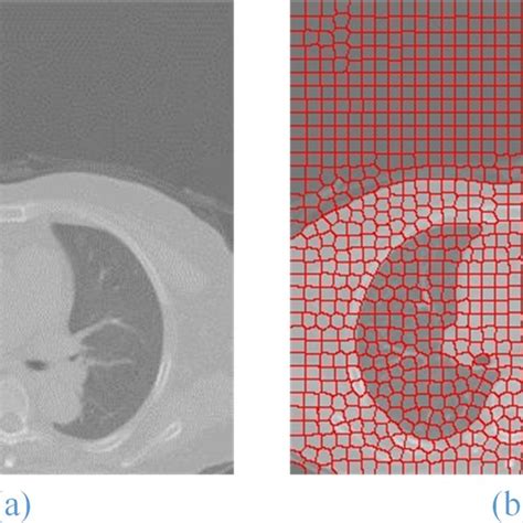 Superpixel Segmentation Result B Of The Original Lung Roi Image A