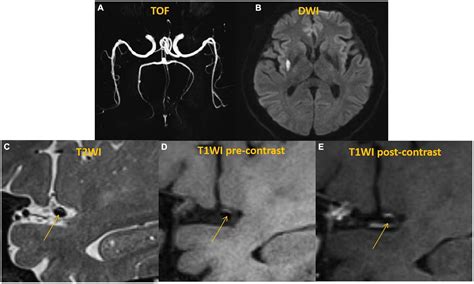 Frontiers Characteristics Of Culprit Intracranial Plaque Without