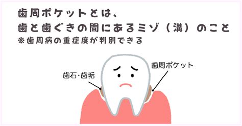 歯周ポケットとは？抜歯回避のための治療法とよくある質問10選 北戸田の歯医者｜北戸田coco歯科