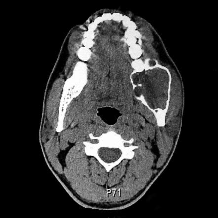 Odontogenic Keratocyst Radiology Reference Article Radiopaedia Org