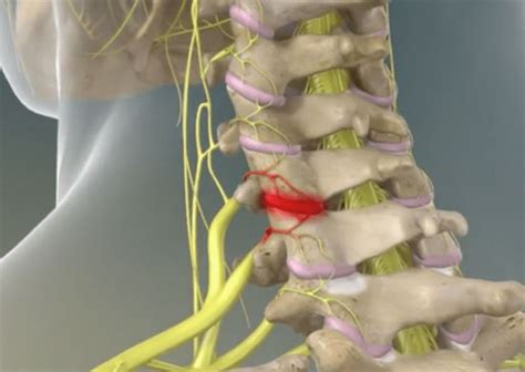 Radiofrequency Ablation – Interventional Spine & Sport Medicine