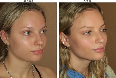 Before And After Pictures Buccal Fat Pad Removal Chicago Face Center