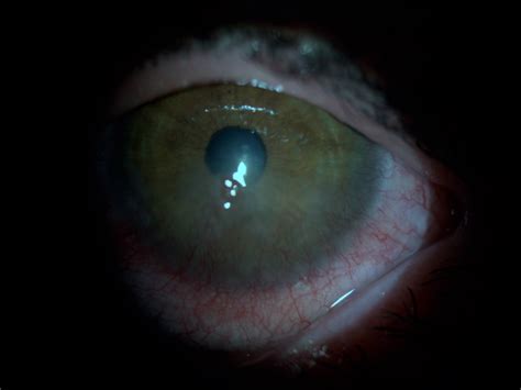 Successful Treatment Of Staphylococcus Associated Marginal Keratitis With Topical Cyclosporine