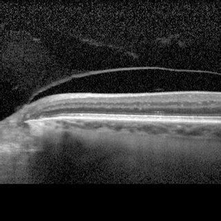 SD-OCT showing a stage II full-thickness macular hole with traction of ...