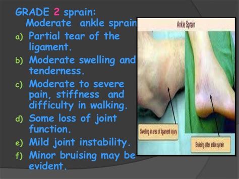 Grade 2 Ligament Sprain - Sprained Ankle Orthoinfo Aaos / The ligament ...