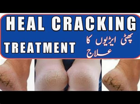 Phati Ariyan Ka Ilaj Heels Cracking Treatment Cracked Heels Home Remedy