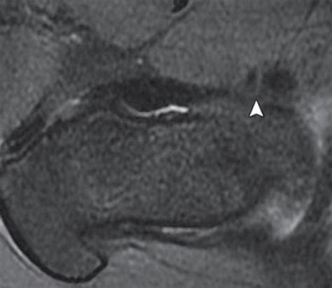 Hip Magnetic Resonance Imaging Recon Orthobullets