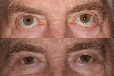 Blepharoplasty Portland Eyelid Surgery Portland Ehnpc