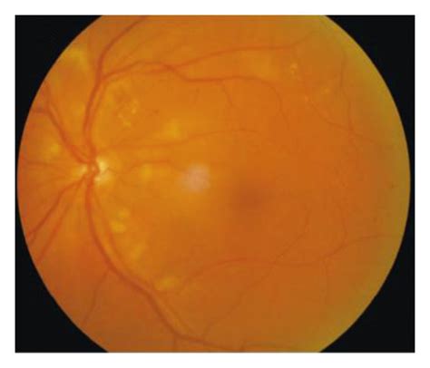 Color Fundus Photography Of Primary Vitreoretinal Lymphoma Pvrl Download Scientific Diagram