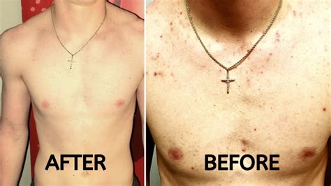 How To Get Rid Of Acne Instantly Youtube