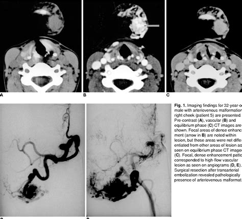 Figure 1 From Head And Neck Vascular Lesions Characterization Of The