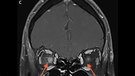 Optic Nerve Lesions