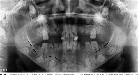 PDF Amelogenesis Imperfecta With Multiple Impacted Teeth And Altered