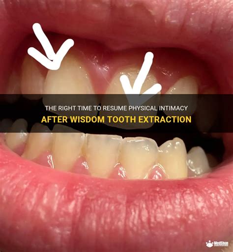 The Right Time To Resume Physical Intimacy After Wisdom Tooth Extraction Medshun