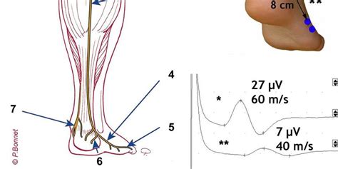 A Origine Et Branches Du Nerf Sural Nerf Fibulaire Commun