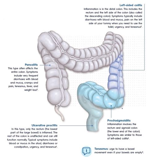 Ulcerative Colitis Articles Dis Chem