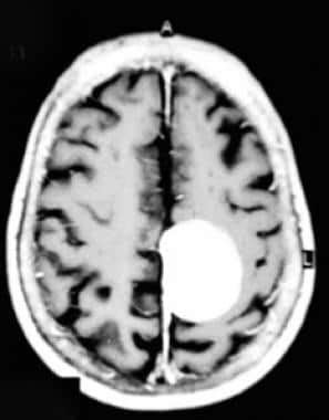 Brain Meningioma Imaging Practice Essentials Radiography Computed