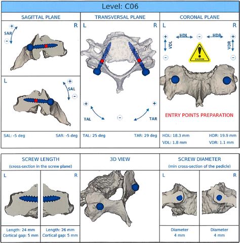 Template Guided Cervical Pedicle Screw Instrumentation North American