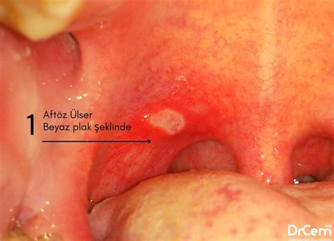 Aftöz Ülser Nedir Belirtileri Nedenleri Tedavisi DRCem