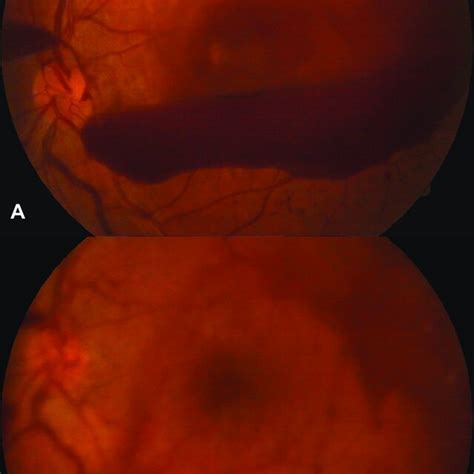 PDF Evaluation Of Pulsed Nd YAG Laser Posterior Hyaloidotomy As An