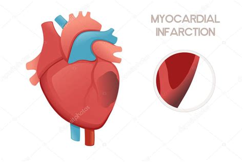 Corazón Humano Insalubre Con Enfermedad Por Infarto De Miocardio