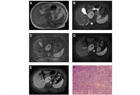 A 36 Year Old Man With Pcv Unicentric Castleman Disease T1 Weighted Download Scientific