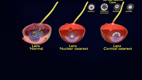 ArtStation - cataract types | Resources