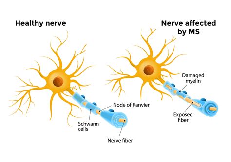 What Is MS? | MS Disease > Multiple Sclerosis NZ 
